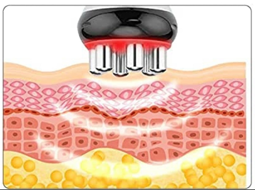 Radio Frequency Body Contouring: Six 30 min Session